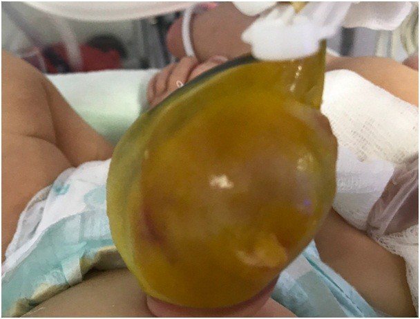 Yenidoğan bebeğe ’omfalosel’ ameliyatı yapıldı