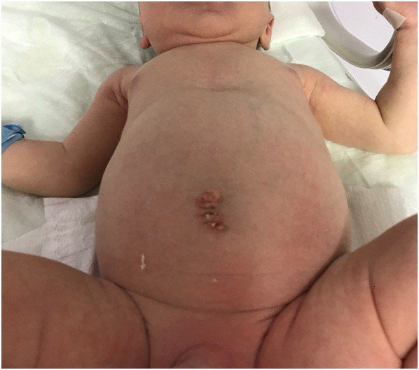 Yenidoğan bebeğe ’omfalosel’ ameliyatı yapıldı
